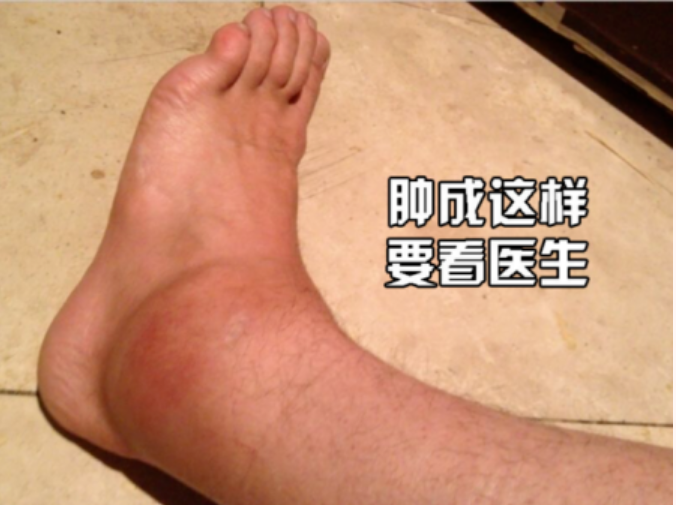 【康医科普】扭伤“脚”该怎么办？