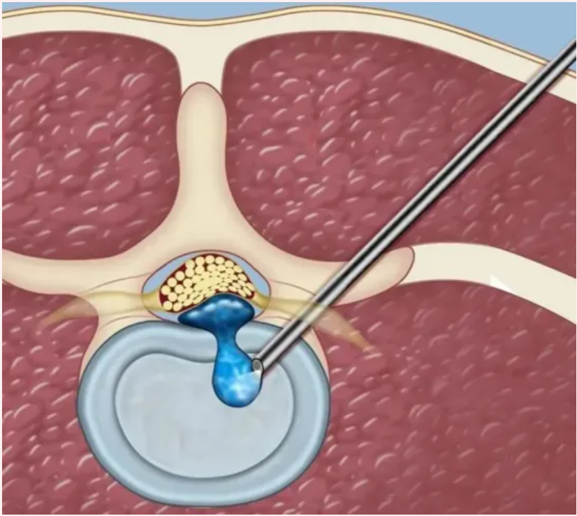 【康医技术】腰腿痛不要慌 椎间孔镜来帮忙